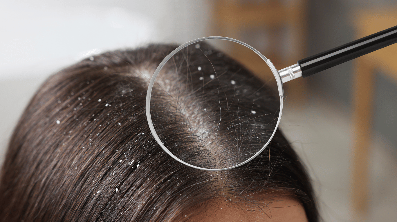 Dandruff-Treatment-Cold-Pressed-Oil